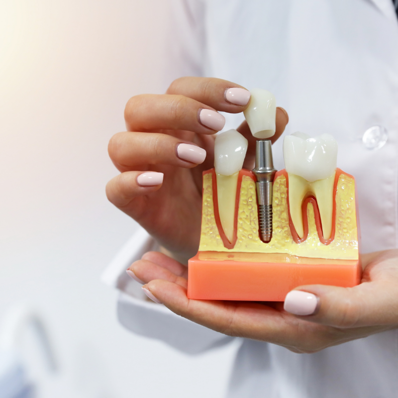 los_angeles_dental_implants