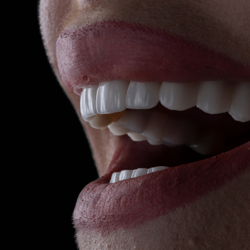 los_angeles_porcelain_veneers