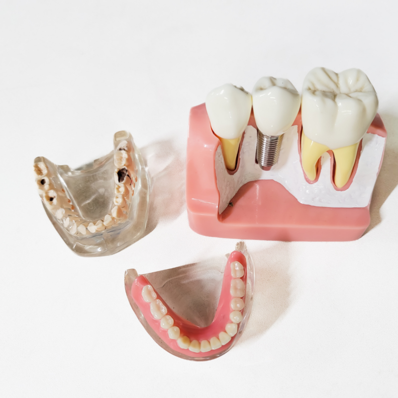 dental_implants_los_angeles