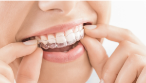 invisalign_los_angeles