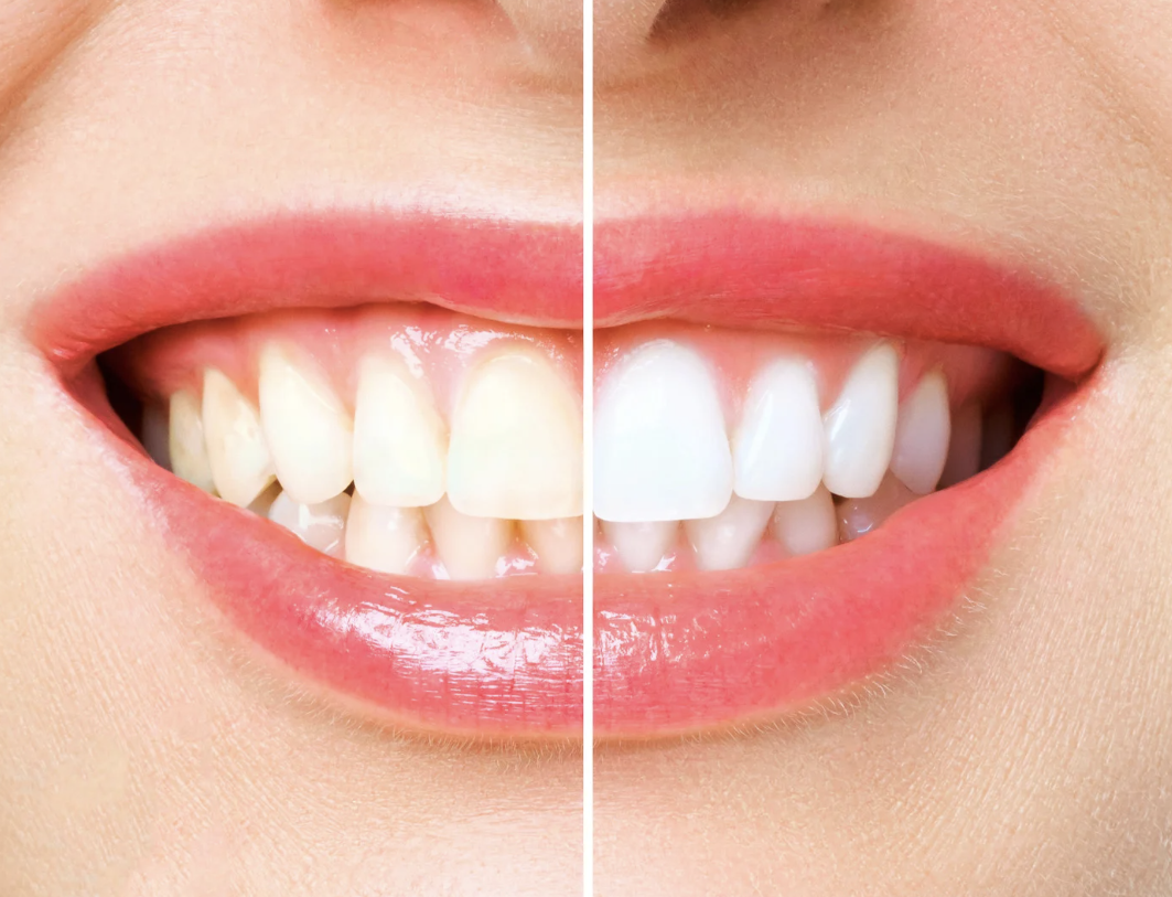 teeth_whitening_los_angeles